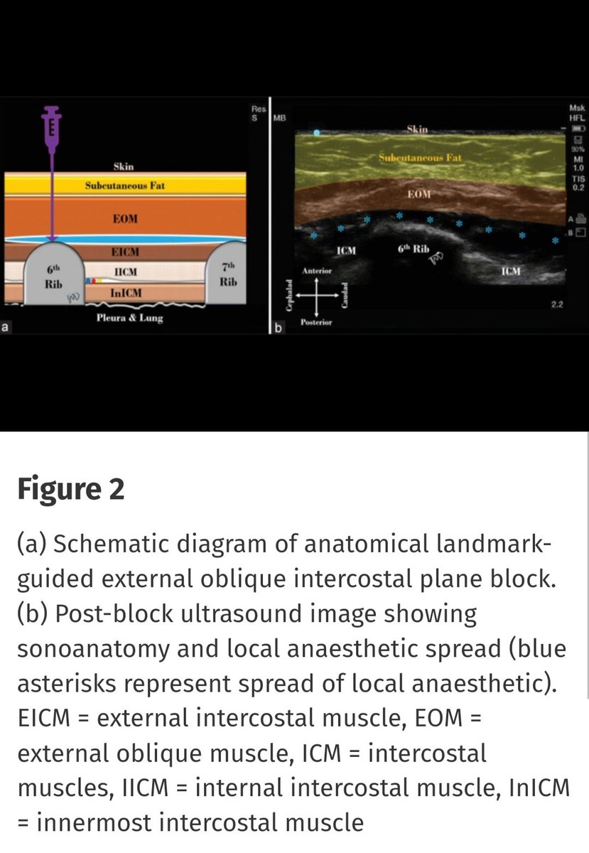 External oblique intercostal plane block: Anatomical landmark-guided technique! Mistry, Tuhin; Sharma, Santosh K; Sonawane, Kartik B. Indian Journal of Anaesthesia 68(5):p 504-505, May 2024. | DOI: 10.4103/ija.ija_172_24