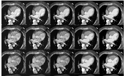 Deep learning-based denoised cardiac CTA images showed significantly lower noise compared to standard methods doi.org/10.1148/ryai.2… @StanfordRad @MarinaCodari @Mastrodicasa_MD #SyntheticData #ML #MachineLearning