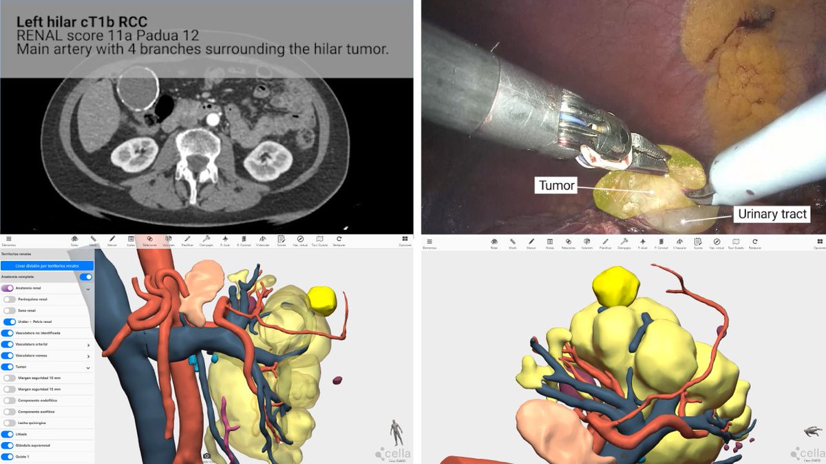 👨🏻‍⚕️El Dr. @vital_hevia presenta 6 casos de #nefrectomíaparcial realizados mediante cirugía robótica, comparando el campo quirúrgico del paciente con las reconstrucciones 3D utilizadas en la planificación previa. Descubre el resultado aquí👇🏻youtu.be/TC91r5lMW0g?si… #EAU24 @Uroweb