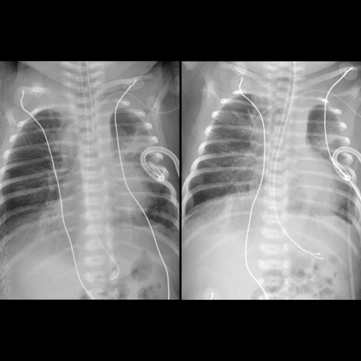 Premature newborn with respiratory distress

CXR(left) shows tip of nasogastric tube to project over body of stomach. Tip of NAVA tube projects over proximal esophagus.

#FOAMed #MedEd #FOAMPed #FOAMRad #PedsRad #RadEd #RadRes #radiology #PedsPulm #NICU #Neonatology #FOAMneo