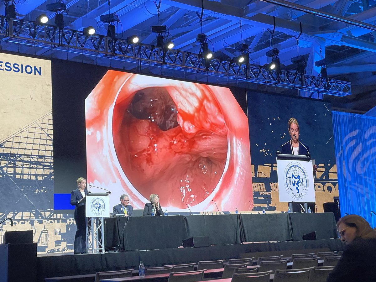 Awesome job @CValukasMD (@purplesurg resident) presenting a complex case of endoscopic treatment for leak after sleeve gastrectomy at @SAGES_Updates #SAGES2024 . On that screen, the leak defect was about 10 feet in diameter!!