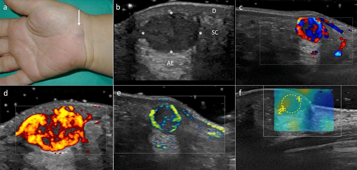 Myopericytoma mimicking subcutaneous melanoma metastasis dlvr.it/T5k3wF