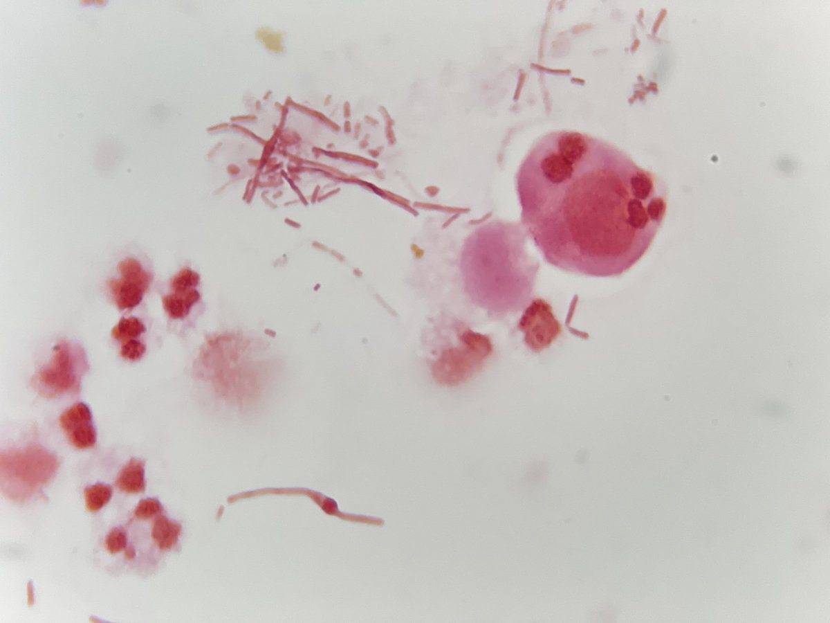 Formas 'L' bacterianas en el sedimento urinario de un paciente que recibe tratamiento con ceftriaxona. A estas morfologías se les ha asociado con resistencia a los beta-lactamicos.
