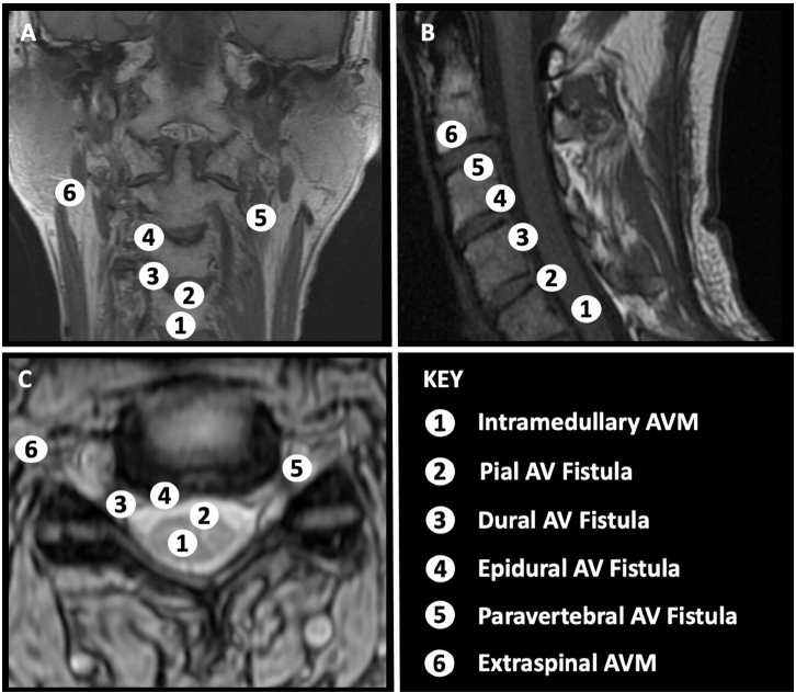 ❔❓ Confused ❔ ❓ about arteriovenous shunts of the cervical spine? @Misikbay @traviscaton @RaghavMattay @WoodyHan2 @mattamansMD Shed light 💡on the topic in their new cohort: bit.ly/3U1UOwz