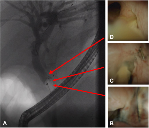 At the Focal Point, Daugherty and Reyes Genere reveal 'Endoscopic findings of a transjugular intrahepatic portosystemic shunt stent eroding into the biliary tract.' giejournal.org/article/S0016-…