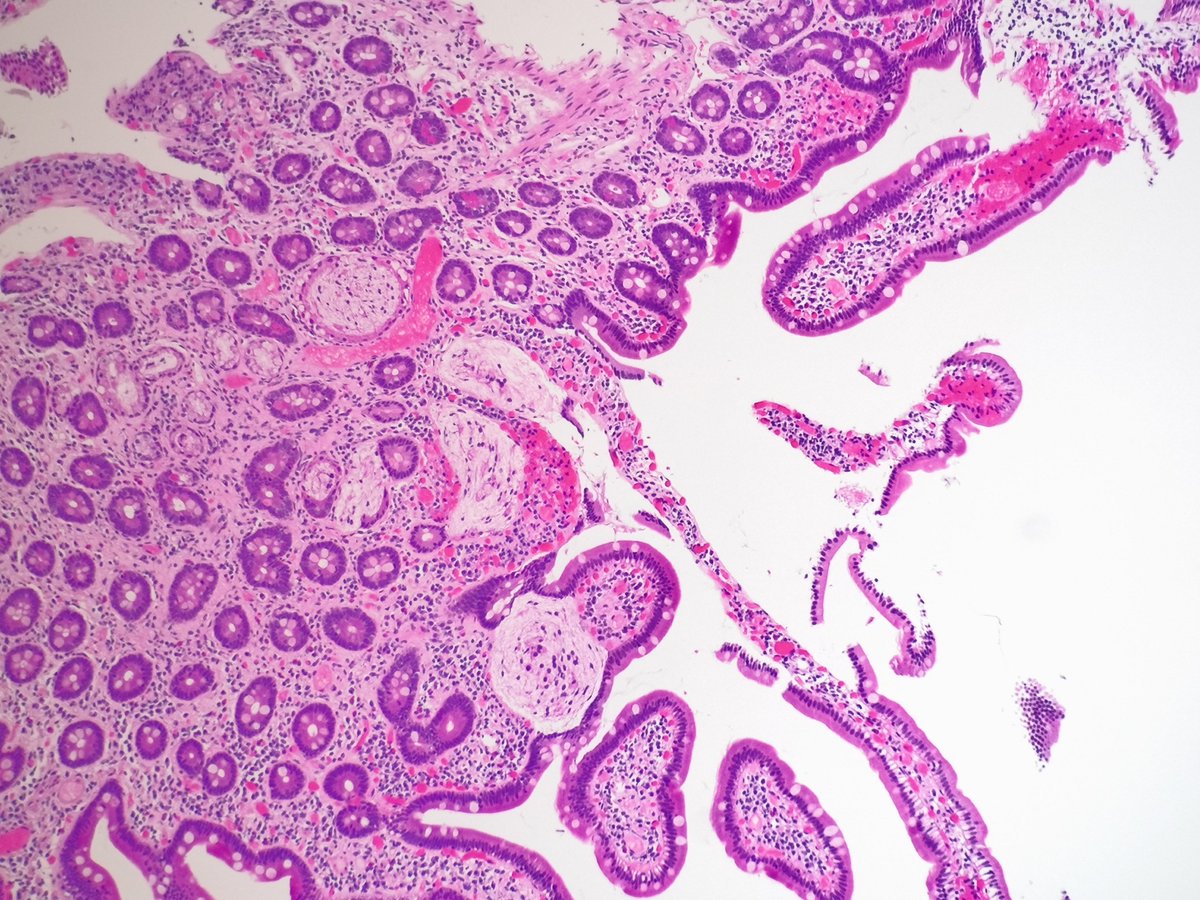 Junior #pathology trainee pitfall alert 🚨

1️⃣ Brunner's glands can be intramucosal, especially in the duodenal bulb
2️⃣ Crushed Brunner's glands may mimic an intra-/submucosal neural proliferation 👇🏻

#beautyintheb9 #GIPath #PathTwitter