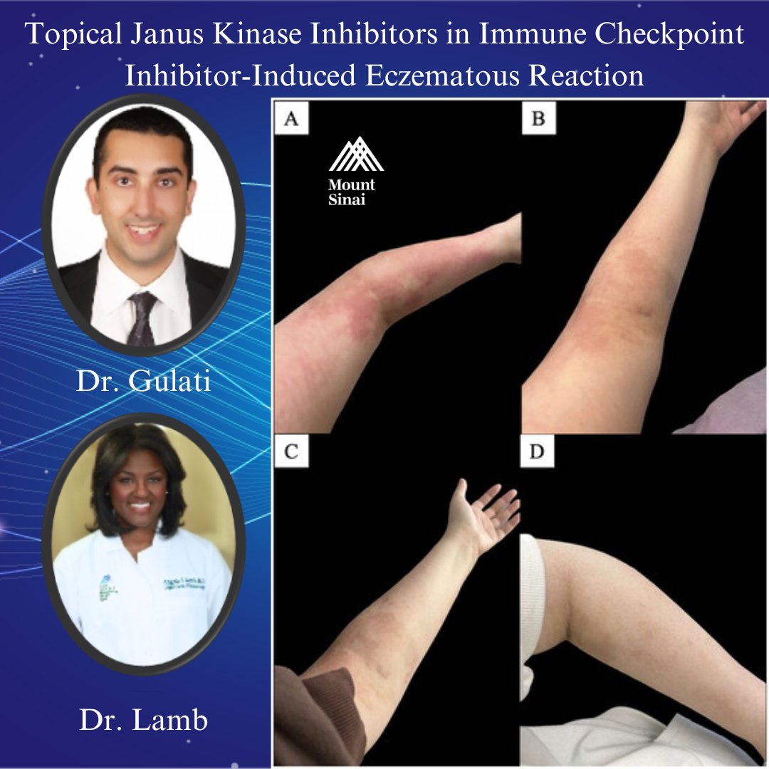 🔬🌟 Drs. Gulati &amp; <a href="/angelalambmd/">Angela Lamb, MD</a> report a novel use of topical ruxolitinib cream to tackle tough ICI-induced eczematous dermatitis in a breast cancer patient. 

🩺bit.ly/topical_JAK💡
<a href="/EmmaGuttman/">Emma Guttman-Yassky</a>