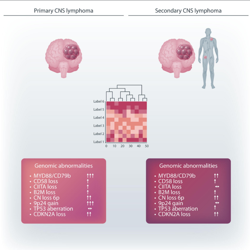 Our Editorial in @Haematologica ➡️ Not all central nervous system lymphomas are created equal haematologica.org/article/view/h… about this important study describing the biology of secondary CNS lymphoma ➡️haematologica.org/article/view/h… @SylvesterCancer