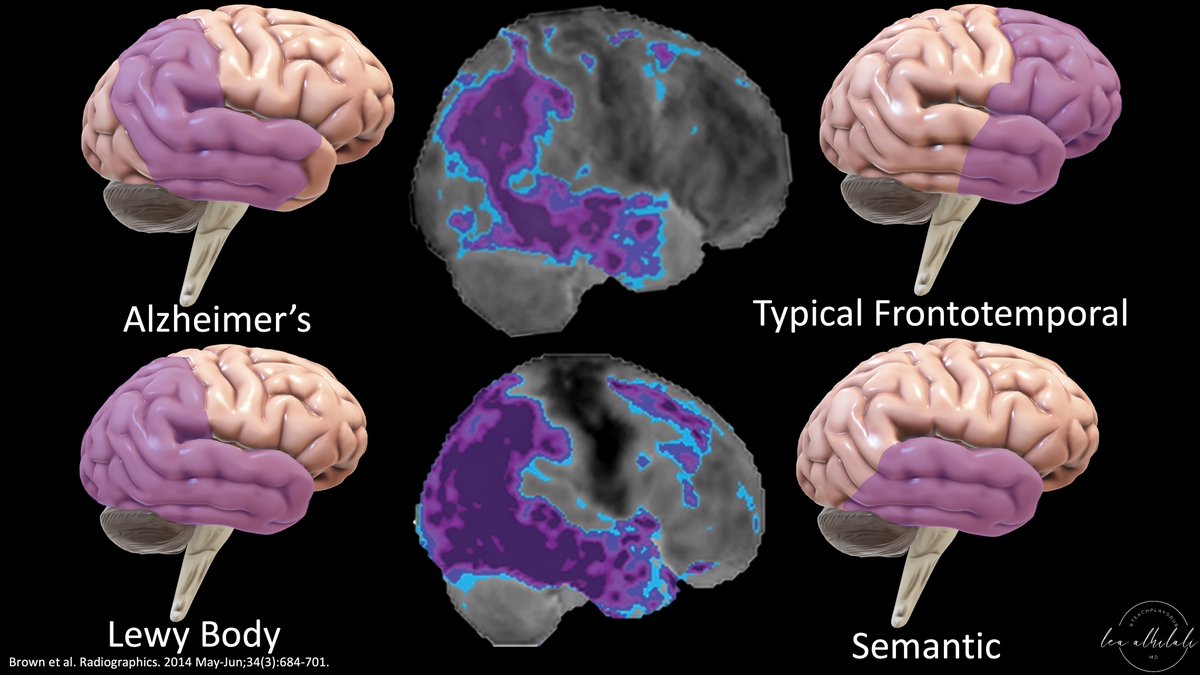 1/Having trouble remembering how to differentiate dementias on imaging? Is looking at dementia PET scans one of your PET peeves? Here’s a thread to show you how to remember the imaging findings in dementia & never forget!