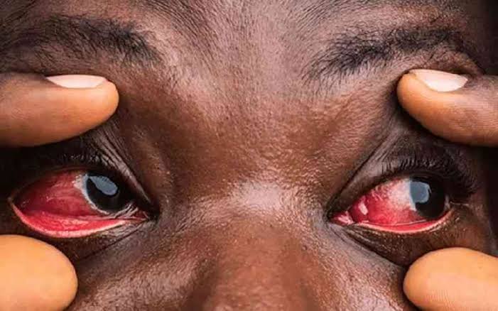 aim_support_ug's tweet photo. Red eye or conjunctivitis 

Conjunctivitis, also known as red eye disease, is a common and contagious eye infection that can spread quickly. It's characterized by redness, itching, and discharge in the eyes. https://t.co/28bSQMTHUN