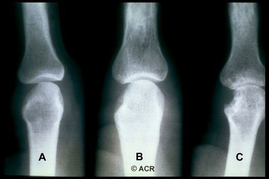 Retrospective study of hand/feet Xrays in early/suspected #RA due to low prevalence of erosions  (4.4%) seldom leading to change in Dx (2pts; 0.3%) or prognosis change (0.4%). Seronegative had less erosions; Longer Sxs not assoc w/ erosions buff.ly/4b1c0Jv