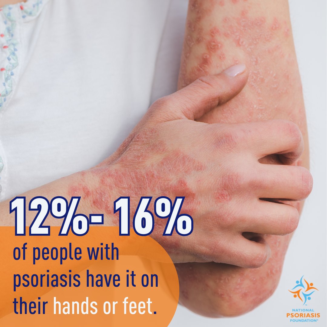 Psoriasis on your hands and feet can be life-changing. Simple tasks become difficult with cracked skin, nail loss, and bleeding. Head to our website to discover more about psoriasis types, symptoms, and treatments. psoriasis.org/advance/when-p…