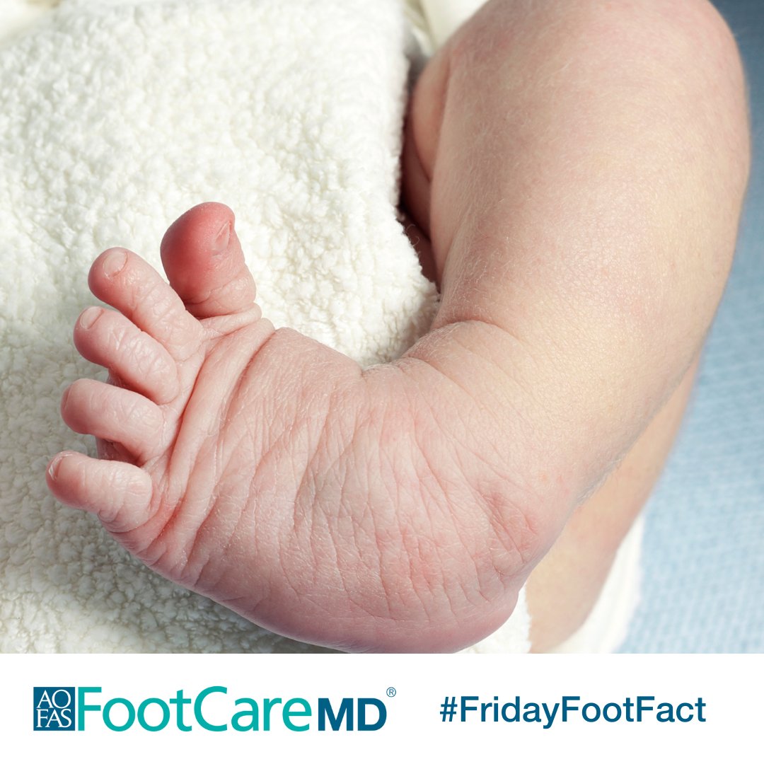 Did you know that a child's foot that curves inward is called a clubfoot? Clubfoot is not painful and can be corrected with treatment. Learn more from #FootCareMD: ow.ly/5hXG50Rj9KN #FridayFootFact