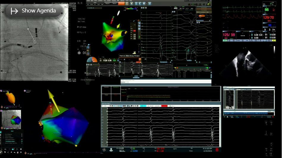 PVC Ablation (CARTO) #EPLiveAustin24 Speaker: @DavidJBurkhard1