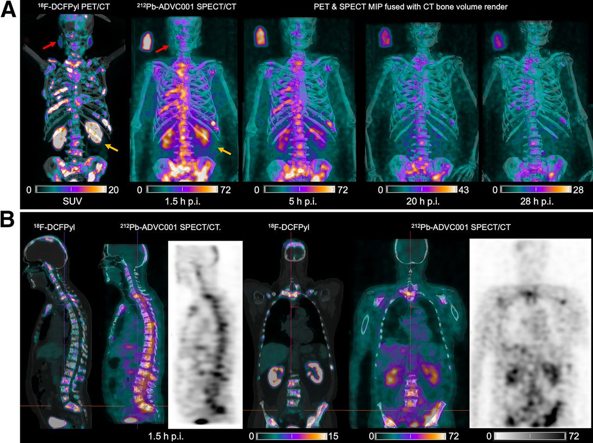 SPECT/CT Technique Detects Radiopharmaceutical Distribution in Prostate Cancer Patients

Learn more ➡️ bit.ly/4d59eET
@JournalofNucMed
#RadNews #RadEd #NuclearMedicine #SPECT #CT #OncologicImaging