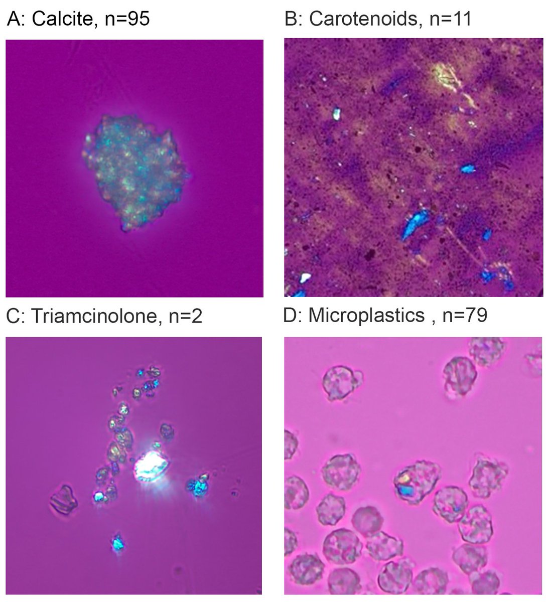 Raman spectroscopic analysis of synovial fluid was a highly specific (99.1%) and sensitive (86.0%) method to identify calcium pyrophosphate in a large cohort of unselected patients, and characterized a large number of objects in synovial fluid In AC&R loom.ly/_yBWplw