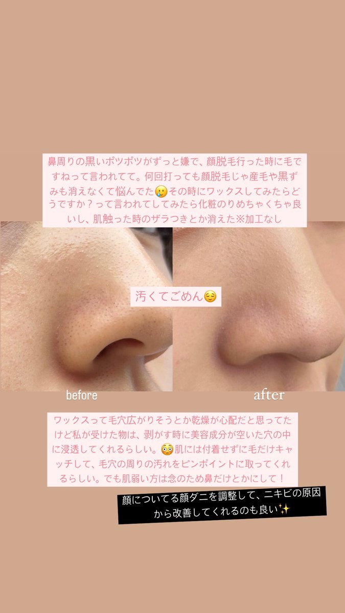 R8807619's tweet photo. ストーリーでめちゃくちゃ聞かれた肌管理！お肌テカテカだねって言われるくらい肌の発光に効果あったので受けた順番に共有🌸

①ポテンツァ（痛くないもの選んだ😣）
②ホクロ取り
③顔ワックス⬅️盲点だった
④白玉酸素セラピー&amp;LEDドーム
＋スキンケアラインはリジュランに変更 https://t.co/Rh65kwDmBn