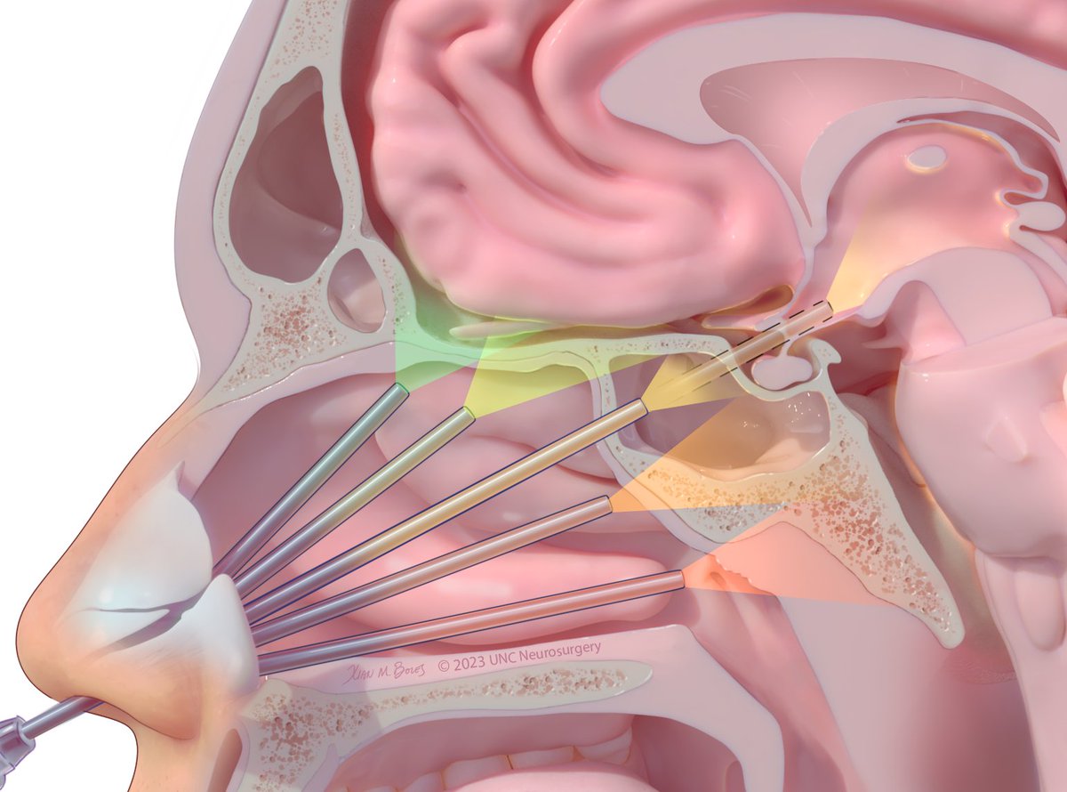 UNCneurosurgery's tweet photo. Endonasal approaches illustrated by @BolesXian.

@UNC_Health_Care is a world leader in expanded endonasal #SkullBaseSurgery &amp; is one of only a few skull base surgery treatment centers in the nation. #UNCNeurosurgery @UNC_ENT 
#MedArt #MedicalIllustration #MedTwitter https://t.co/mCYoVak1cl