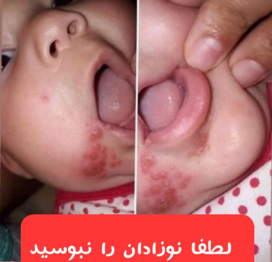 'دختر ۷ ماهه به تبخال مبتلا شده است! این مورد با ویروس قابل انتقال است! این توئیت برای هشدار دادن به مادران است تا با بقیه به اشتراک بگذارید و بگویید (بوسیدن کودک ممنوع!) ...' #بوسیدن_نوزاد_ممنوع