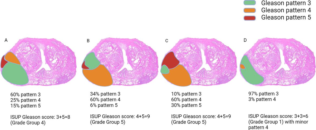 Math Matters! In this newly released article @EUplatinum, Alessia @AlessiaCim & her colleagues @GGiannarini provide a compelling argument for a change in Gleason grading for RRP #prostatecancer and discard “tertiary”terminology from pathology reporting sciencedirect.com/science/articl…