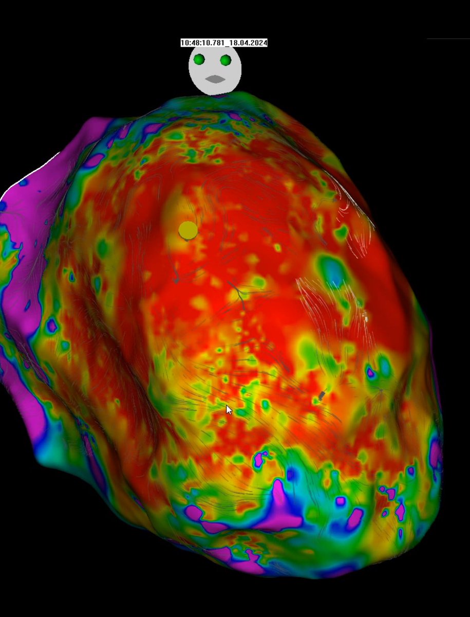 @RSupryn @Phiso_de @melhamriti @BiosenseWebster @Abiomed Thanks for your comment. Here is the voltage map showing a huge scar in this left ventricle.