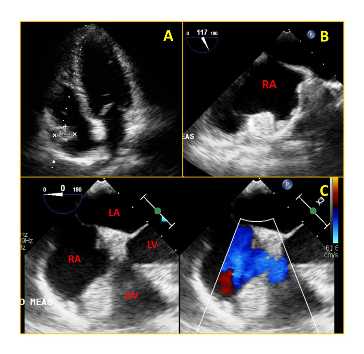 Image challenge: Right atrial mass. A middle-aged patient with well-controlled hypothyroidism presented with exertional dyspnoea for a few years. General and systemic examinations were within normal limits. bit.ly/437uaGM