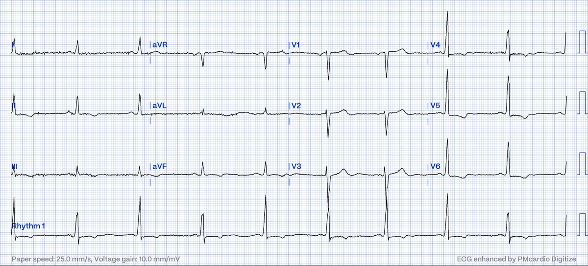 ECG1 caught my eyes in the reading queue. Looking back, found ECG2.

Known nonischemic dilated cardiomyopathy.

Thoughts?