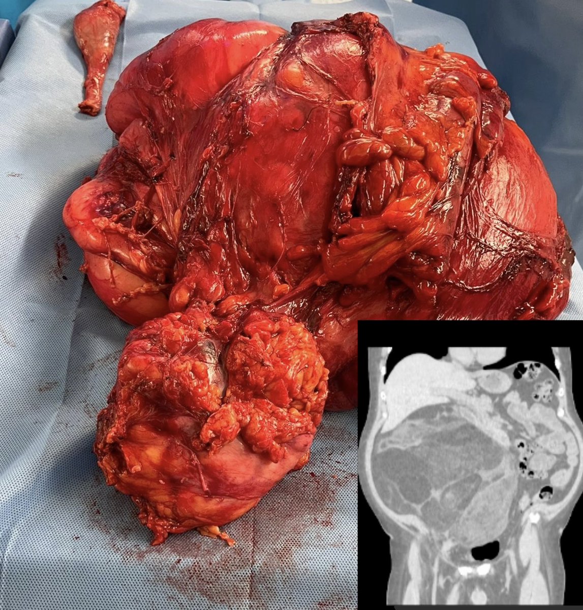 Compartamentectomía retoperitoneal derecha por sarcoma pleomorfo ⁦@rdgzgarciaonco⁩ ⁦@cuellarluis⁩ ⁦@infantesoyer⁩ ⁦@Surgicalberserk⁩ #retroperitonealsarcoma