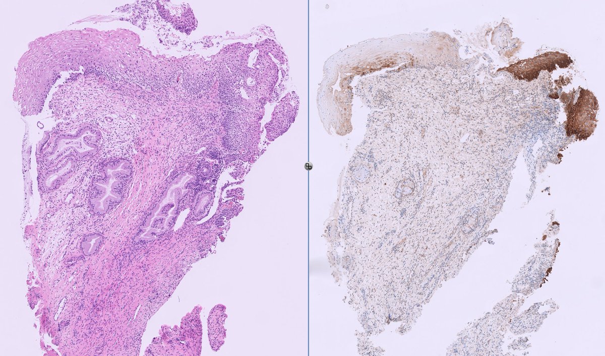 kis_lorand's tweet photo. Not everything that shines (and is brown 😁) is HSIL 👇👇👇
#pathology #pathtwitter #gynpath 
The IHC is p16 https://t.co/glC5P9ZJgl