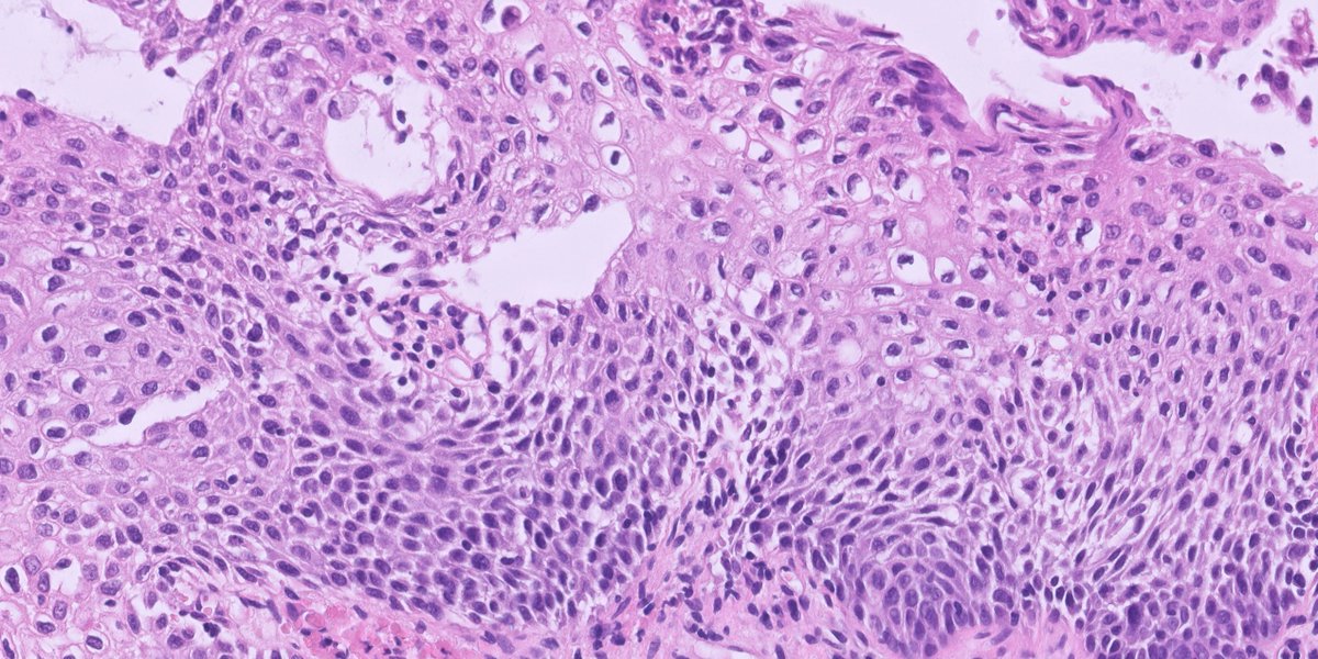 kis_lorand's tweet photo. Not everything that shines (and is brown 😁) is HSIL 👇👇👇
#pathology #pathtwitter #gynpath 
The IHC is p16 https://t.co/glC5P9ZJgl