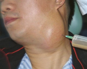 Gazal6849's tweet image. 🟣𝘾𝙇𝙄𝙉𝙄𝘾𝘼𝙇 𝙎𝘾𝙀𝙉𝙀𝙍𝙄𝙊:

📝A 40yr old ♂️ p/w classic #triad of Ipsilateral conductive hearing loss,#palatal asymmetry &amp;amp; #trigeminal neuralgia along with cystic swelling at neck

What is possible diagnosis ❓

#medx
@fxgodzeuss
@IhabFathiSulima