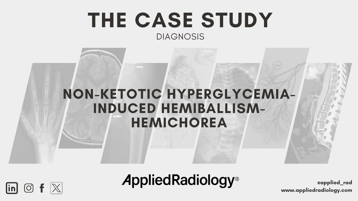 🩻 Case Study of the Week!

Non-ketotic hyperglycemia-induced hemiballism-hemichorea

See all the case details, more images, and diagnosis ➡️ bit.ly/3Q2OALV

#RadEd #Radiology #CaseOfTheWeek #RadRes #CaseStudy