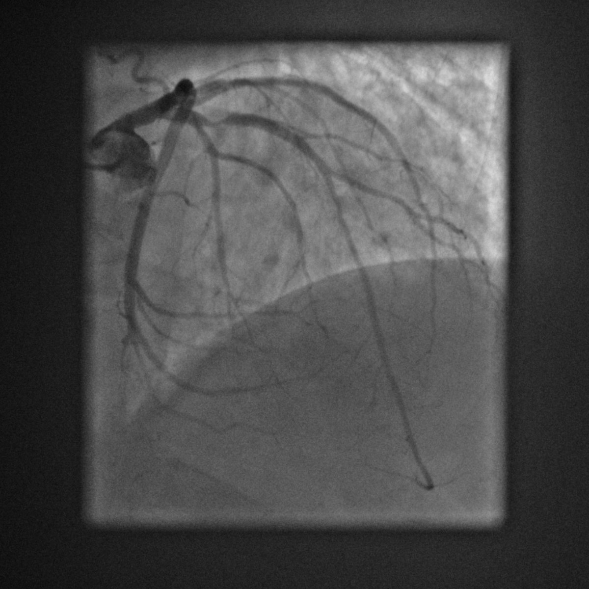 nicolasamabile's tweet photo. 77 y-o man, severe dyspnea , aortic valve stenosis (Mean Gradient : 40 Hgmm ) , tight calcified excentric lesion on proximal LAD / rudimentary RCA- Heart team decision : LAD PCI and subsequent TAVR-
We decided to propose a CALIPSO-style OCT-guided PCI https://t.co/JkoT4Sh8N1
