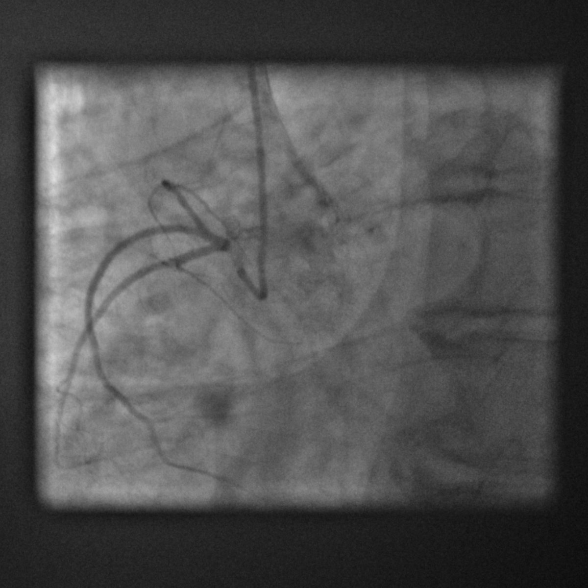 77 y-o man, severe dyspnea , aortic valve stenosis (Mean Gradient : 40 Hgmm ) , tight calcified excentric lesion on proximal LAD / rudimentary RCA- Heart team decision : LAD PCI and subsequent TAVR-
We decided to propose a CALIPSO-style OCT-guided PCI