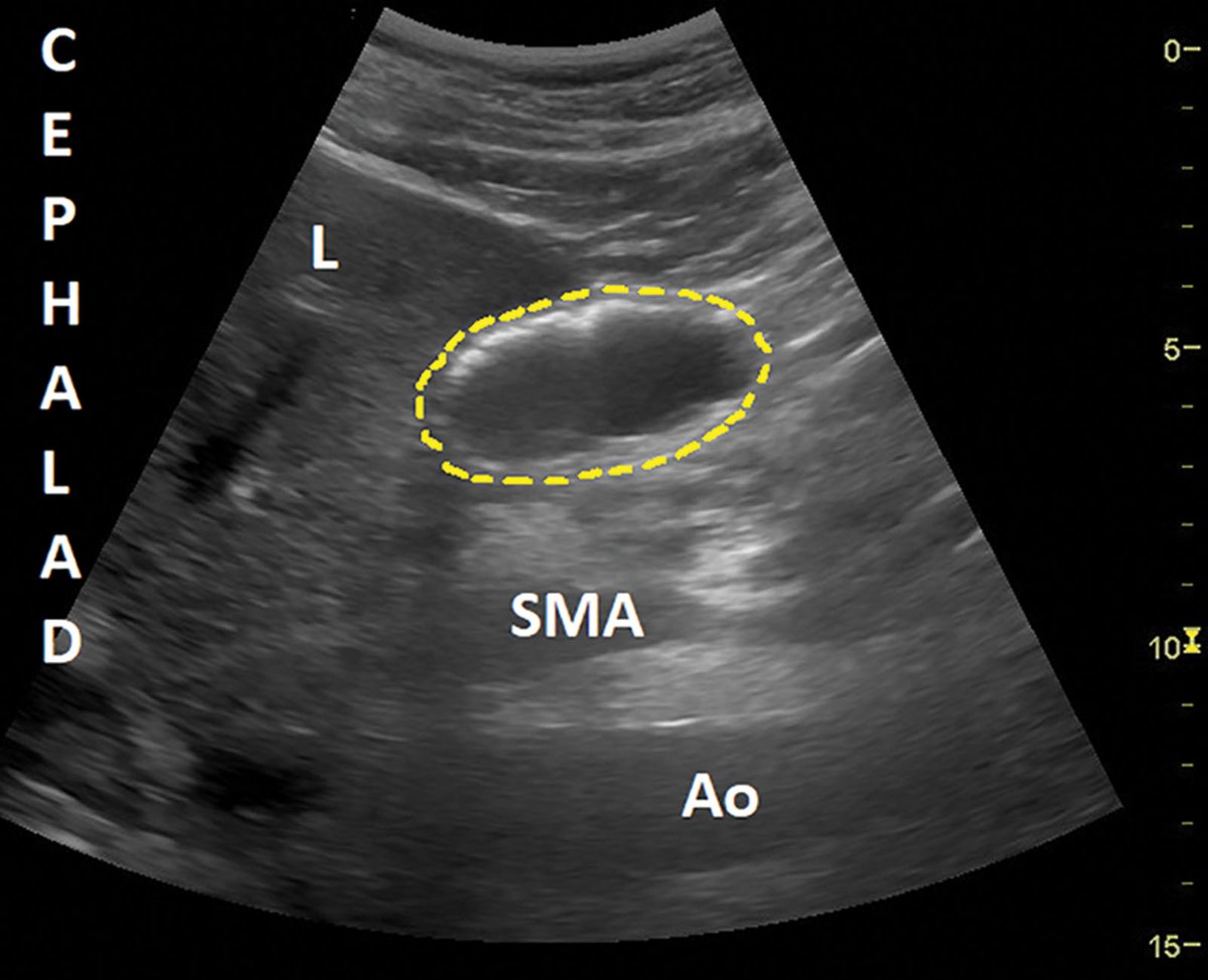 In a new article, researchers identified measures can be used to define the upper limit of normal gastric volume values for fasted subjects using point-of-care ultrasound, which may have clinical utility in establishing aspiration risk. Learn more: ow.ly/ptNE50Rk22F