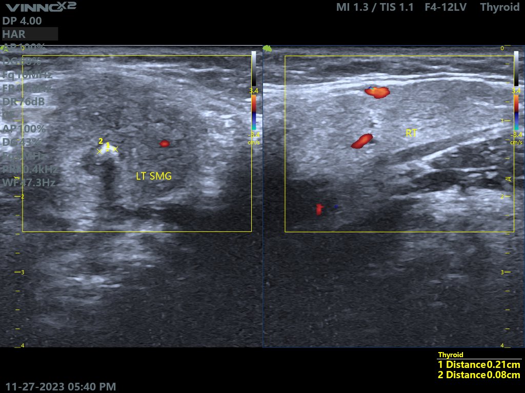 EchoTech_4's tweet photo. Middle age female c/o left Submandibular pain especially during eating. https://t.co/0JY3bYl8HM