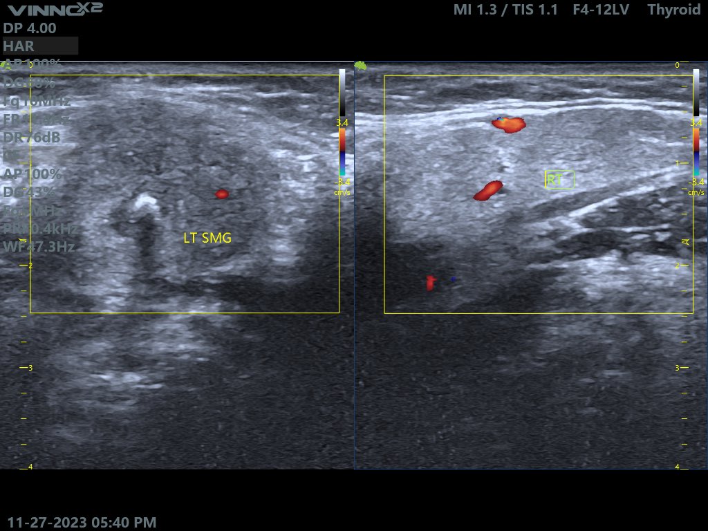 EchoTech_4's tweet photo. Middle age female c/o left Submandibular pain especially during eating. https://t.co/0JY3bYl8HM