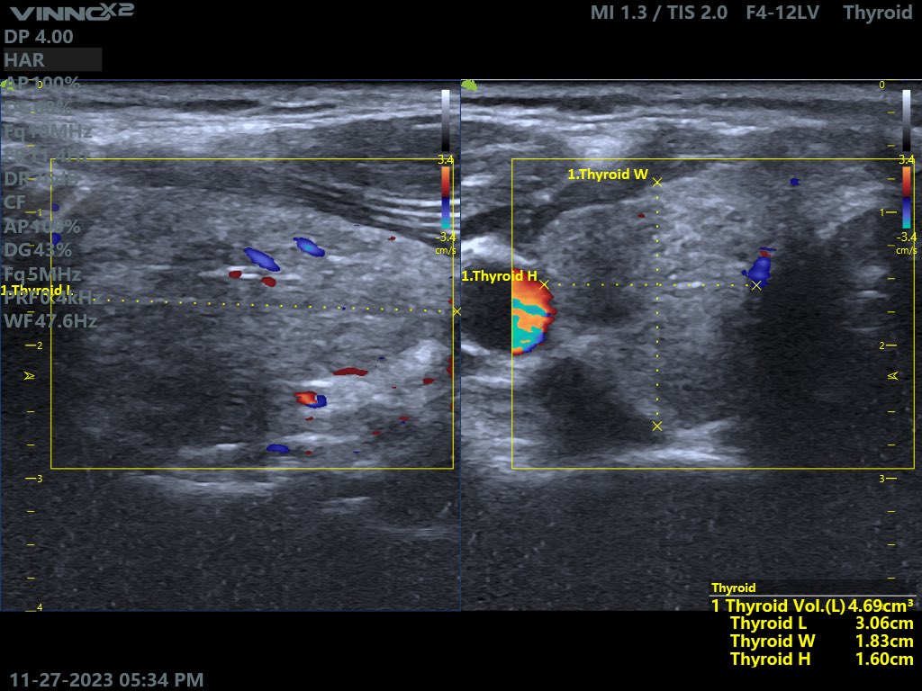 EchoTech_4's tweet photo. Middle age female c/o left Submandibular pain especially during eating. https://t.co/0JY3bYl8HM