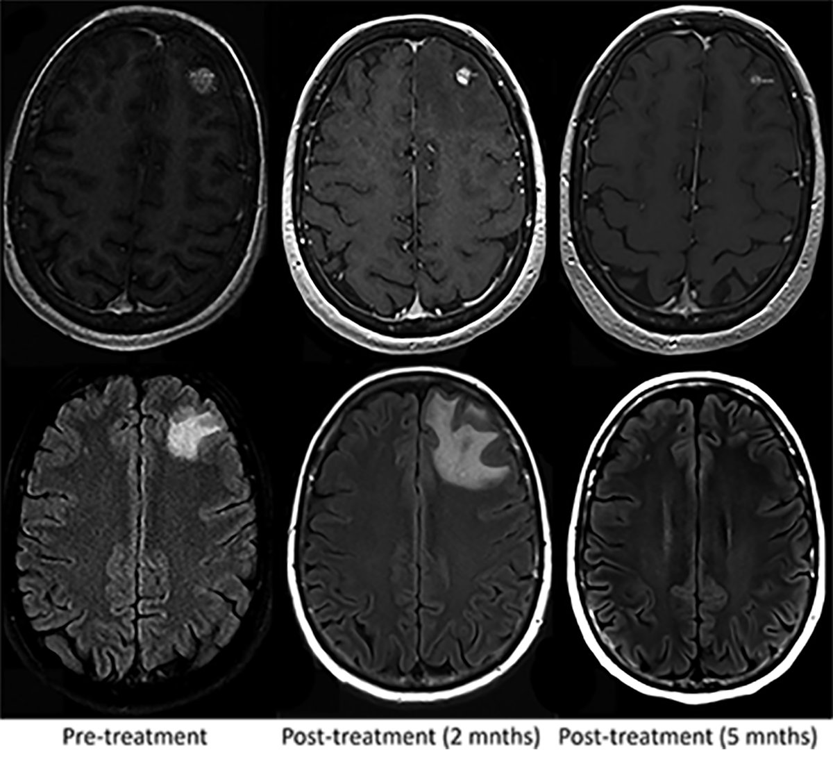 Case Study: Role of Boswellia Serrata in Management of CNS Radiation Necrosis After Radiosurgery for Brain Metastases

Learn more ➡️ bit.ly/48mCy6n
#RadOncEd #BrainCancer #HeadAndNeckCancer #OHANCAW #CancerAwareness