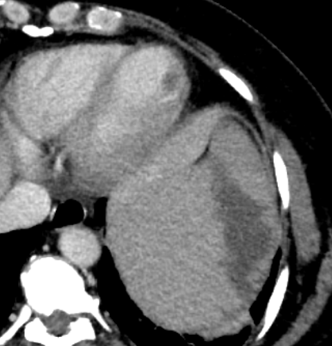 Outpatient imaging report turnaround times can matter...

Shown here: splenic infarct and LV thrombus on a single image.