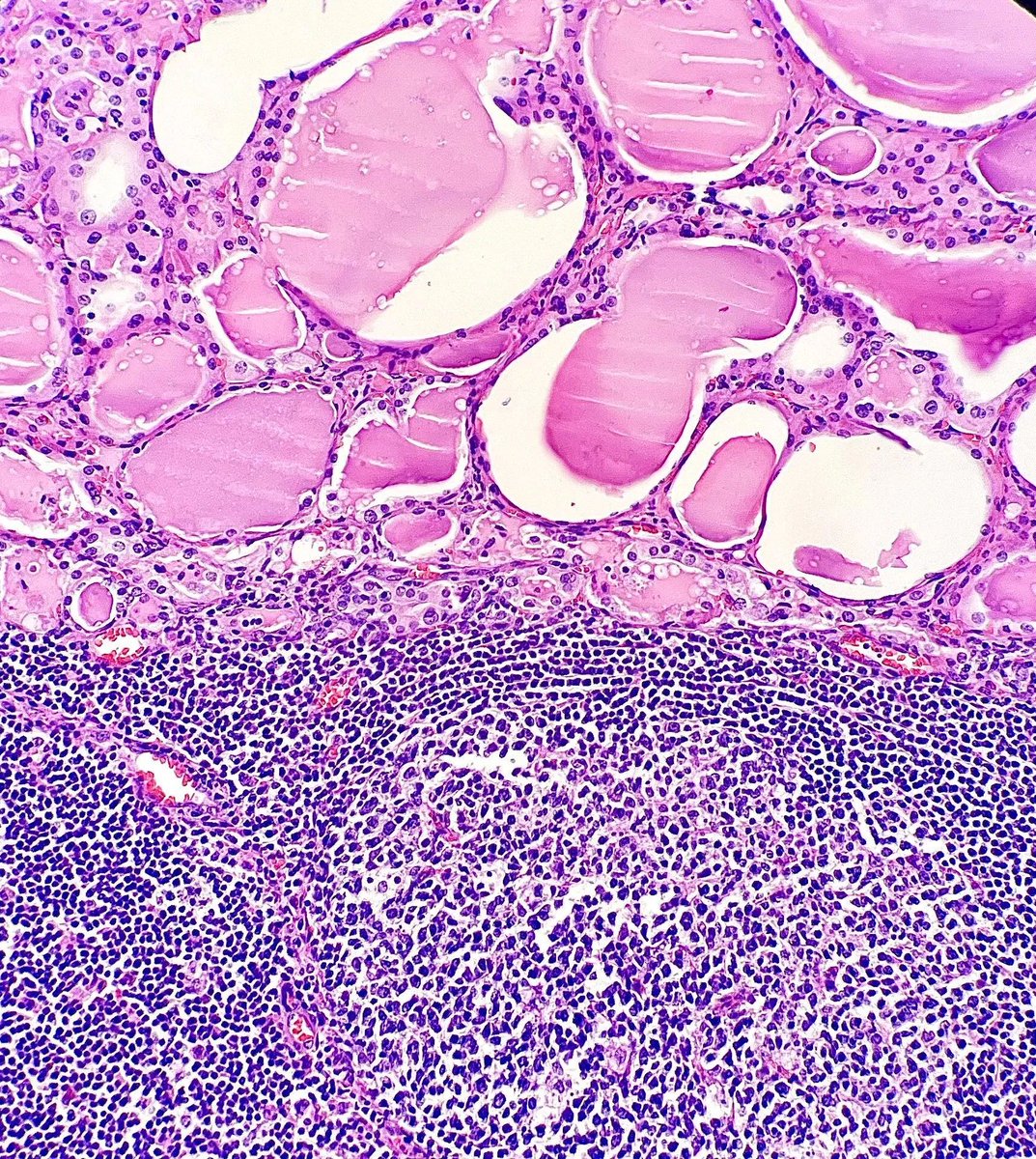 Thyroidectomy showing a lymphocytic infiltrate with germinal center formation adjacent to thyroid follicles with oncocytic change. What is the diagnosis? Answer: buff.ly/3Utn511 #PathArt #PathTwitter #MedTwitter