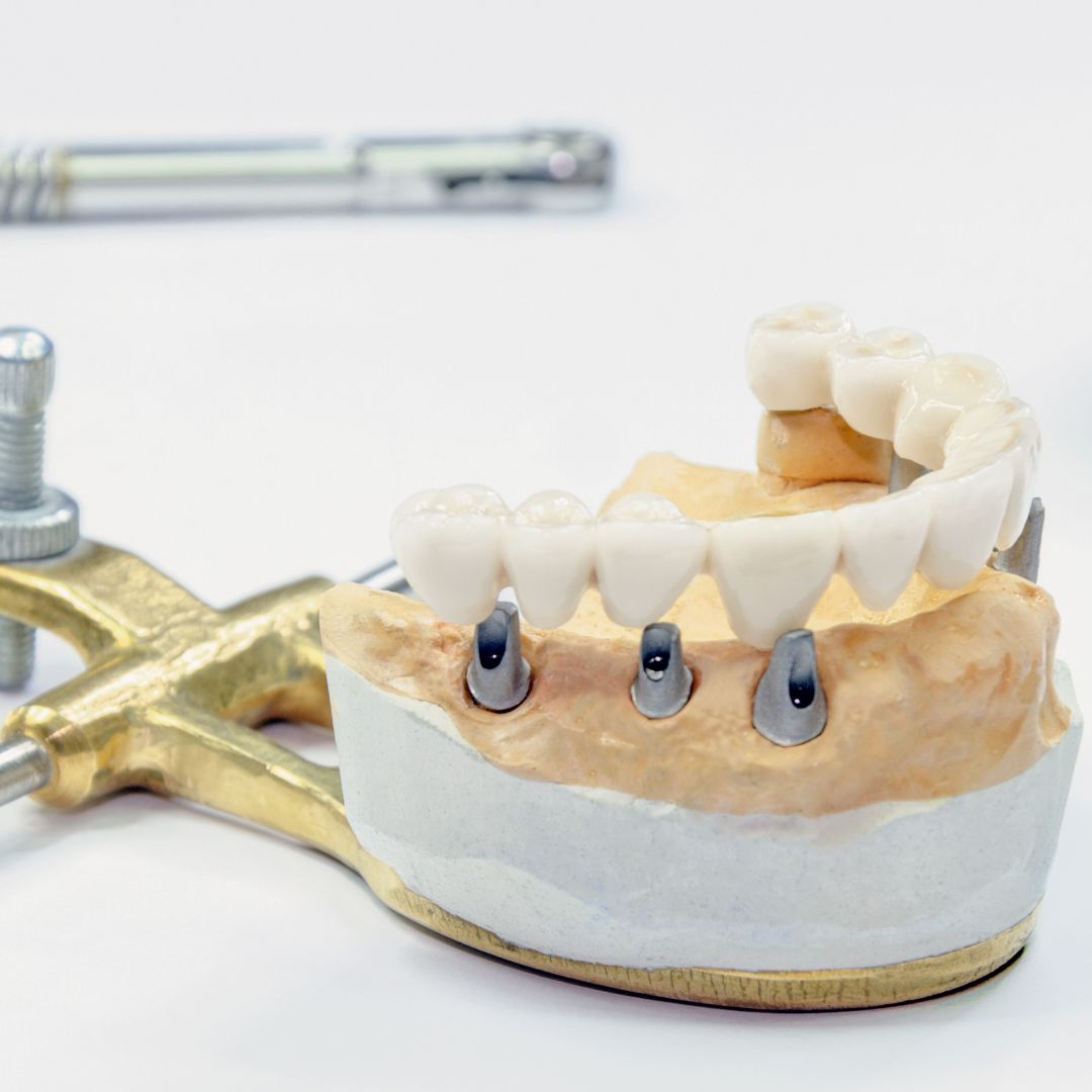 Through our precision and attention to detail, we are able to create stunning outcomes that leave a lasting impression on those we serve. 

Learn More: buff.ly/3UB98y3
#ReliableDentalLab #DentalRestoration #DentalLab #DentalImplants