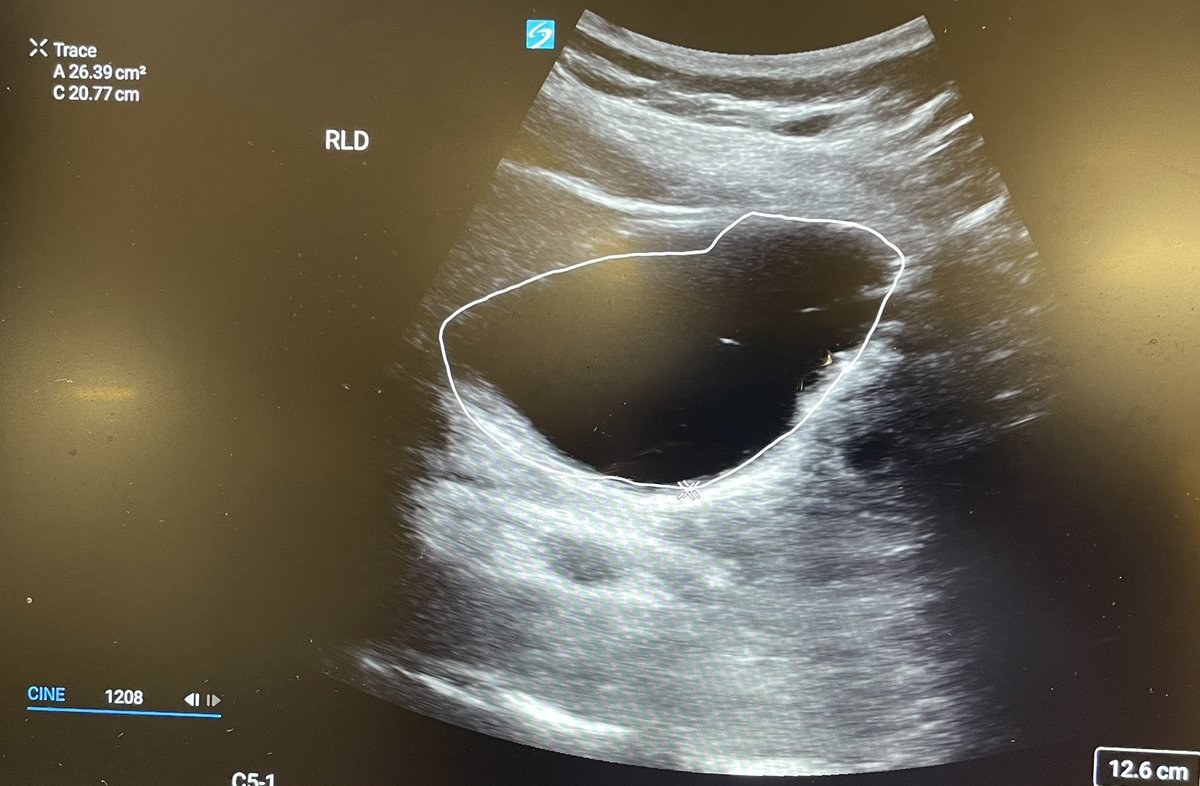 #POCUS Pearls for #gastricultrasound 1st image …. Looks empty ?? Supine Watch out 2nd image: 👿 fluids !! RLD Never pass the 🪣 without RLD imaging for empty and fluids in Antrum!! 🔥CSA👇🏿26 cm2 @ASRA_Society @PerlasAnahi @shaskinsMD @Siva6faces @MKwesiKwofie @Nadia_Hdz_MD