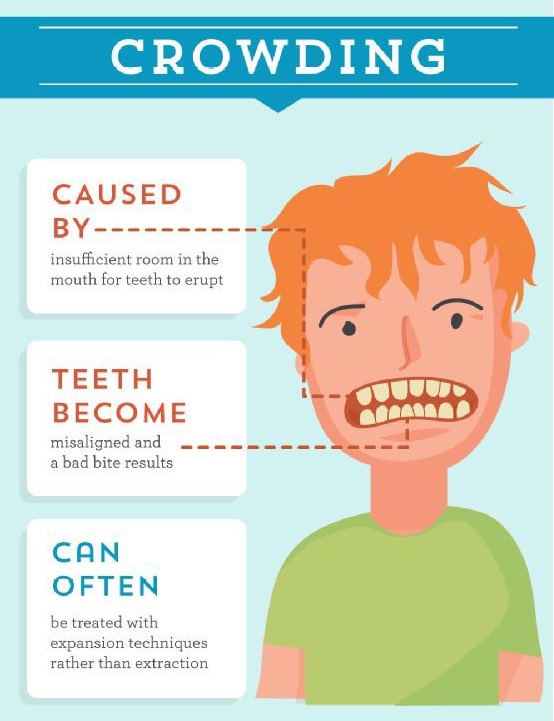 Overcrowded #teeth can harm #oralhealth [#Infographic]