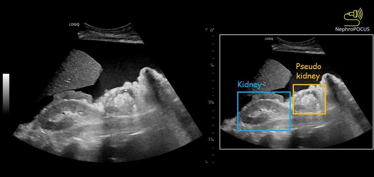 #POCUS caution ⚠️
Sometimes, bowel can be mistaken for kidney. (especially in #hepatorenal cases with ascites and low quality images). Paying attention to the anatomy and recognizing vascular pattern on color Doppler help.
#Nephpearls #FOAMed