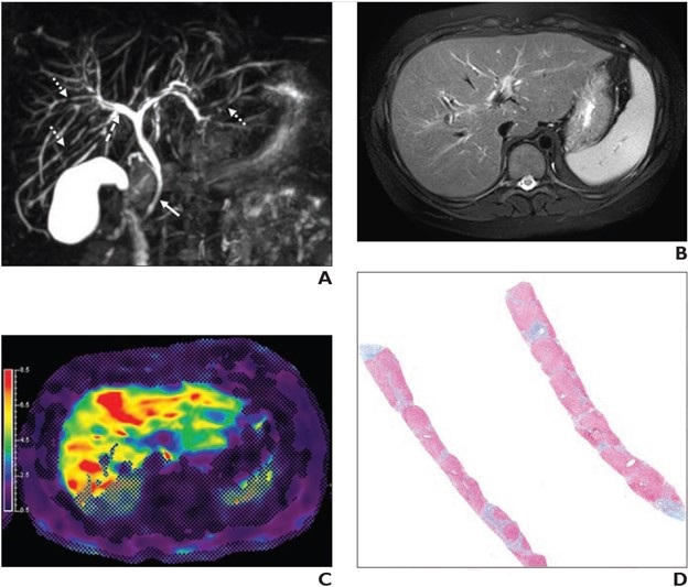 Study Supports Use of MRE for Monitoring Pediatric Autoimmune Liver Disease

Learn more ➡️ bit.ly/3UpgK6o
@AJR_Radiology
#RadNews #RadEd #PediatricImaging