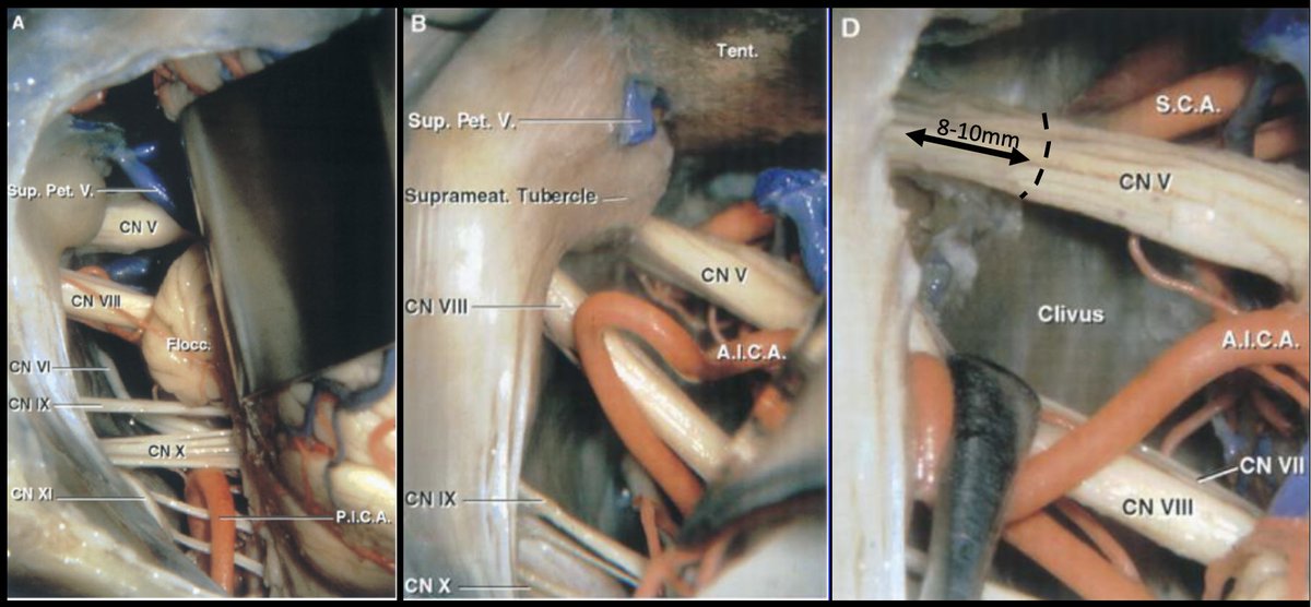 #MorcosChallenge Drilling the suprameatal tubercle allows additional 8-10mm view of CN5 within Meckel’s cave improving access to mfossa & surgical freedom around porus of CN5. Does not increase exposure of ventral brainstem/clivus @EvaWuMD @UTHNeuro @medclinicalcase @nasbsorg