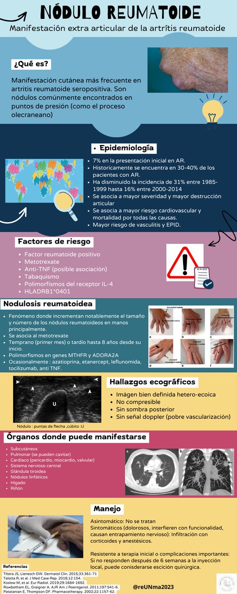 Infografía de Nodulo Reumatoide

Manifestación extra articular muy frecuente en AR

#visualabstracsUN