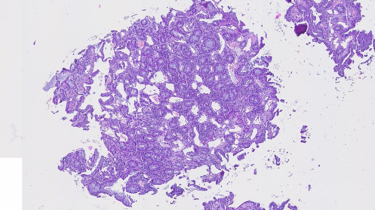 DraEosina's tweet image. Definitely the best example of ☢️radiation colitis☢️ I've ever seen.
Angiectatic vessels are so prominent; they even show superficial thrombi.
#GiPath #Pathology