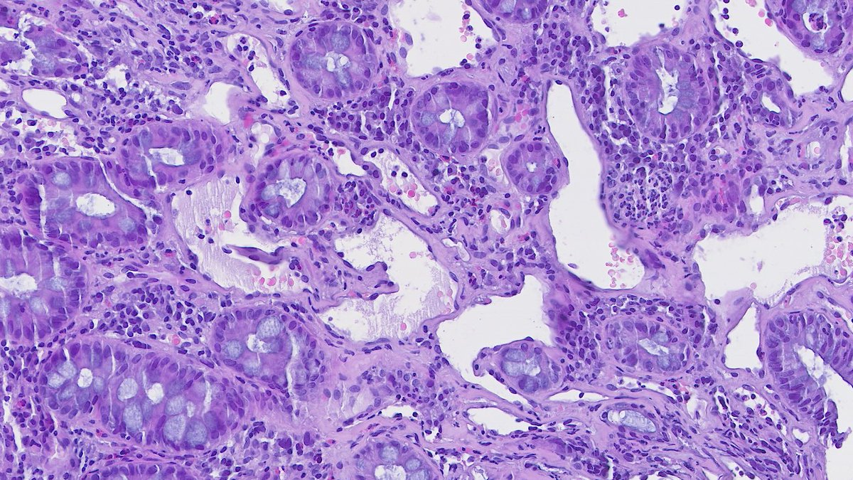 DraEosina's tweet image. Definitely the best example of ☢️radiation colitis☢️ I've ever seen.
Angiectatic vessels are so prominent; they even show superficial thrombi.
#GiPath #Pathology